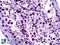 TPX2 Microtubule Nucleation Factor antibody, LS-B5672, Lifespan Biosciences, Immunohistochemistry paraffin image 
