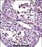 Autoimmunogenic cancer/testis antigen NY-ESO-2 antibody, PA5-71845, Invitrogen Antibodies, Immunohistochemistry paraffin image 