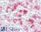 Nasopharyngeal carinmoma  antibody, LS-B6977, Lifespan Biosciences, Immunohistochemistry paraffin image 