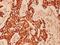 Keratin 10 antibody, A02305Y160, Boster Biological Technology, Immunohistochemistry paraffin image 