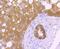 Carbonic Anhydrase 9 antibody, A01083-2, Boster Biological Technology, Immunohistochemistry paraffin image 
