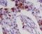 S100A8 antibody, M00413-1, Boster Biological Technology, Immunohistochemistry paraffin image 
