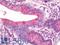 Preferentially Expressed Antigen In Melanoma antibody, LS-B10827, Lifespan Biosciences, Immunohistochemistry frozen image 