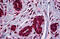 MDM2 Proto-Oncogene antibody, MBS245687, MyBioSource, Immunohistochemistry paraffin image 