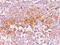 Premelanosome Protein antibody, M19774, Boster Biological Technology, Immunohistochemistry paraffin image 