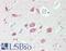 Carbonic Anhydrase 9 antibody, LS-B15818, Lifespan Biosciences, Immunohistochemistry paraffin image 