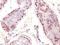 Melanoma-associated antigen 1 antibody, M03570, Boster Biological Technology, Immunohistochemistry paraffin image 