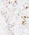 Melanoma-associated antigen D2 antibody, IHC-00237, Bethyl Labs, Immunohistochemistry paraffin image 