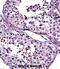 Autoimmunogenic cancer/testis antigen NY-ESO-2 antibody, abx027593, Abbexa, Immunohistochemistry paraffin image 