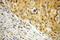 NME1 antibody, 11086-2-AP, Proteintech Group, Immunohistochemistry paraffin image 