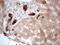 Phosphoglycerate Dehydrogenase antibody, M03355, Boster Biological Technology, Immunohistochemistry paraffin image 