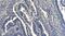 Hydroxypyruvate Isomerase (Putative) antibody, A14191-2, Boster Biological Technology, Immunohistochemistry paraffin image 