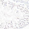 Zinc finger protein GLI1 antibody, A00527-1, Boster Biological Technology, Immunohistochemistry paraffin image 