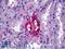 Mucin 1, Cell Surface Associated antibody, LS-B5243, Lifespan Biosciences, Immunohistochemistry paraffin image 
