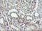 F-Box Protein 42 antibody, M13796, Boster Biological Technology, Immunohistochemistry paraffin image 