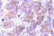 ALK Receptor Tyrosine Kinase antibody, AP20921PU-N, Origene, Immunohistochemistry paraffin image 