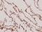 SNCG antibody, A03523-1, Boster Biological Technology, Immunohistochemistry paraffin image 