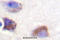 Protein Tyrosine Kinase 2 antibody, A00151Y570, Boster Biological Technology, Immunohistochemistry paraffin image 