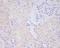 Matrix Metallopeptidase 14 antibody, M00656, Boster Biological Technology, Immunohistochemistry paraffin image 