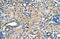 Aspartyl/asparaginyl beta-hydroxylase antibody, GTX45856, GeneTex, Immunohistochemistry paraffin image 