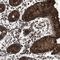 Mucin 1, Cell Surface Associated antibody, HPA007235, Atlas Antibodies, Immunohistochemistry paraffin image 