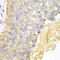 Epithelial Cell Adhesion Molecule antibody, LS-C331328, Lifespan Biosciences, Immunohistochemistry paraffin image 
