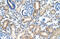Mucin 1, Cell Surface Associated antibody, ARP41445_P050, Aviva Systems Biology, Immunohistochemistry paraffin image 