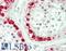 MAGE Family Member A3 antibody, LS-B14514, Lifespan Biosciences, Immunohistochemistry paraffin image 