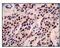 Estrogen Receptor 1 antibody, ab32063, Abcam, Immunohistochemistry paraffin image 