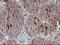 Matrix Metallopeptidase 13 antibody, LS-C797732, Lifespan Biosciences, Immunohistochemistry paraffin image 