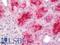 MAGE Family Member A3 antibody, LS-C789017, Lifespan Biosciences, Immunohistochemistry paraffin image 