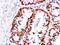 hMSH6 antibody, AE00186, Aeonian Biotech, Immunohistochemistry paraffin image 