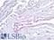 Mesothelin antibody, LS-A12009, Lifespan Biosciences, Immunohistochemistry paraffin image 