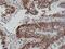 MutS Homolog 6 antibody, M00553-1, Boster Biological Technology, Immunohistochemistry paraffin image 