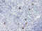 Ribosomal Protein S6 Kinase B1 antibody, M01475-3, Boster Biological Technology, Immunohistochemistry paraffin image 