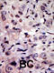 ALK Receptor Tyrosine Kinase antibody, 63-025, ProSci, Immunohistochemistry paraffin image 