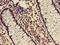 5-Aminoimidazole-4-Carboxamide Ribonucleotide Formyltransferase/IMP Cyclohydrolase antibody, LS-C396158, Lifespan Biosciences, Immunohistochemistry paraffin image 