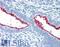 Mucin 16, Cell Surface Associated antibody, LS-B2829, Lifespan Biosciences, Immunohistochemistry paraffin image 