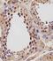 Insulin Like Growth Factor 2 MRNA Binding Protein 1 antibody, A02007-1, Boster Biological Technology, Immunohistochemistry paraffin image 