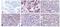 Plasminogen Activator, Urokinase Receptor antibody, MON U-16-02, Invitrogen Antibodies, Immunohistochemistry paraffin image 