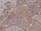 SMAD Family Member 4 antibody, M00074-1, Boster Biological Technology, Immunohistochemistry paraffin image 