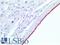 Mesothelioma antibody, LS-C95544, Lifespan Biosciences, Immunohistochemistry paraffin image 
