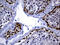 Insulin Like Growth Factor 2 MRNA Binding Protein 3 antibody, M02362, Boster Biological Technology, Immunohistochemistry paraffin image 