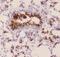Mucin 1, Cell Surface Associated antibody, PB9112, Boster Biological Technology, Immunohistochemistry paraffin image 