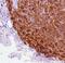 ALK Receptor Tyrosine Kinase antibody, MA5-16320, Invitrogen Antibodies, Immunohistochemistry paraffin image 