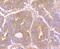 Stress Induced Phosphoprotein 1 antibody, A02683-1, Boster Biological Technology, Immunohistochemistry paraffin image 
