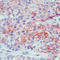 Mesothelin antibody, LS-C87690, Lifespan Biosciences, Immunohistochemistry paraffin image 