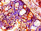 Histone Cluster 1 H1 Family Member B antibody, LS-C673227, Lifespan Biosciences, Immunohistochemistry paraffin image 