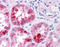 Mucin 1, Cell Surface Associated antibody, ARP41502_P050, Aviva Systems Biology, Immunohistochemistry paraffin image 