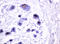 Mucin 1, Cell Surface Associated antibody, LS-C175472, Lifespan Biosciences, Immunohistochemistry frozen image 